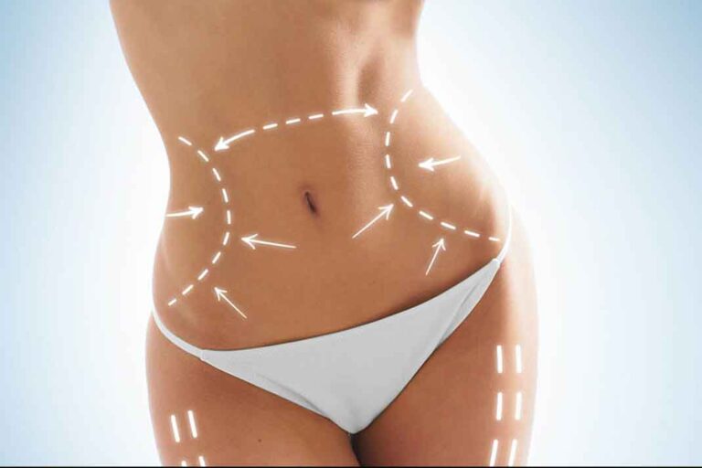 El exceso de piel que te queda después de perder peso, tiene remedio.