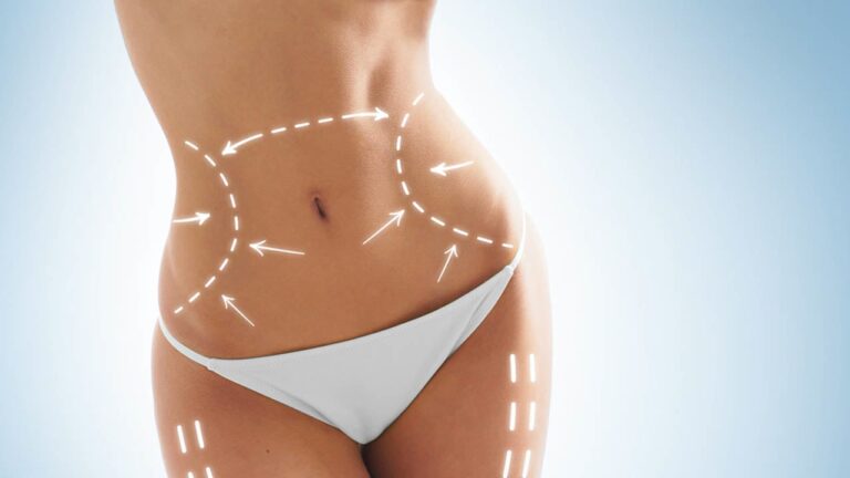 Tummy Tuck
