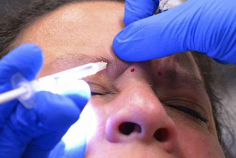 Dr, ¿el Botox es bueno para mí aunque estoy joven?