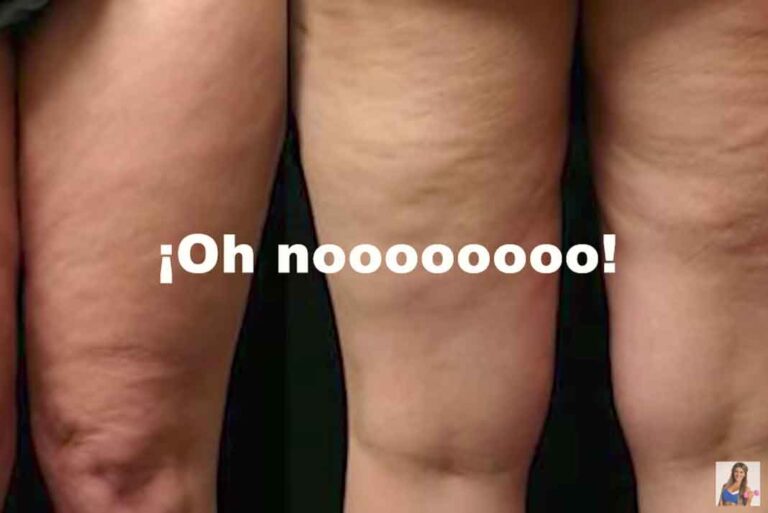 ¿Celulitis en las piernas? Los mejores ejercicios para eliminarla