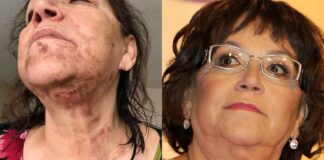 Así quedó Doña Rosa después del accidente casero