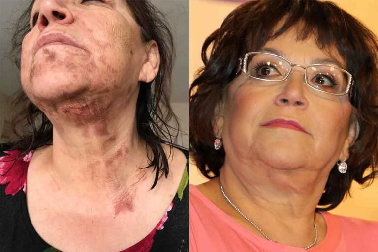 Así quedó Doña Rosa después del accidente casero