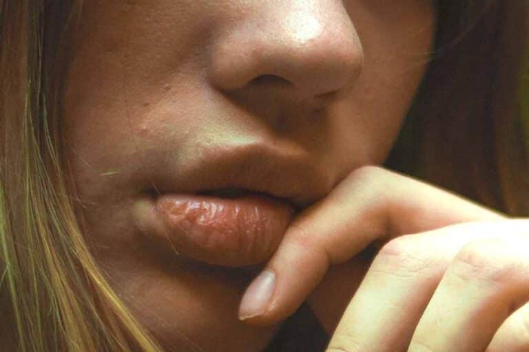 Dr. Wolf: ¿Te pusieron rellenos en labios y te salieron ampollas? ¡Cuidado!