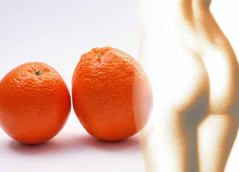 Dr. Wolf: ¿Cómo me quito la celulitis?