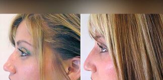 rinoplastia