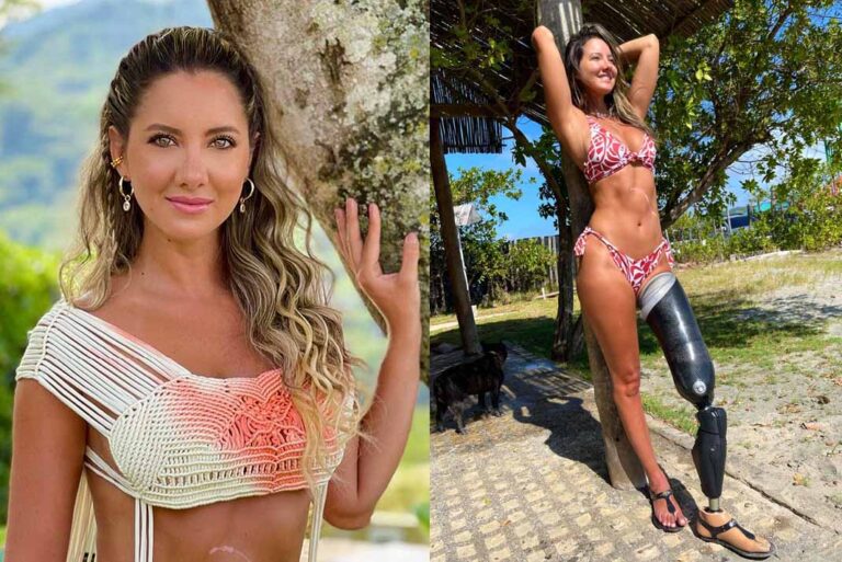 Ex reina de belleza que perdió una pierna sorprendida de cómo reaccionan los hombres al verla