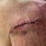 Mostró la cicatriz de la operación con 12 puntadas de sutura