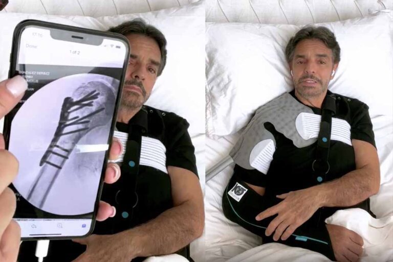 Eugenio Derbez narra "accidente estúpido" que le dejó 15 fracturas y hasta un año de recuperación