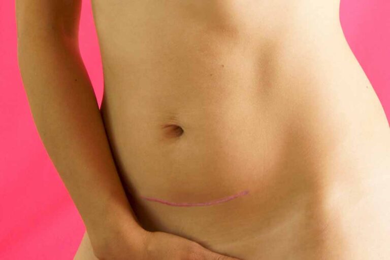 Dr. Wolf: ¿Se puede eliminar la cicatriz de una cesárea?