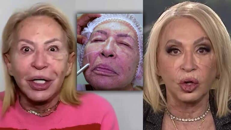 Laura Bozzo se puso hilos tensores y colágeno para rejuvenecer su