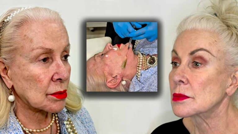 "Muertos de hambre": Laura Zapata estalla con quienes critican su rejuvenecimiento facial