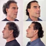 El actor quedó satisfecho (y también sus seguidores) con los resultados, diciéndole que se había quitado 20 años de encima y que estaba listo para volver a las telenovelas