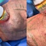 El especialista le hizo después una radiofrecuencia con microagujas para quitar el exceso de piel y hacer un estiramiento facial