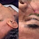 Por último, el Dr. Gabush le hizo una armonización facial inyectándole ácido hialurónico para marcarle la madíbula, rellenarle el mentón, aumentarle los pómulos y disminuirle las ojeras