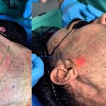 El doctor marcó la cara del actor para pasar por debajo de la piel un láser llamado Endolyse, que eliminar grasa localizada, estimula la producción de colágeno y ayuda a eliminar la flacidez del rostro y el cuello