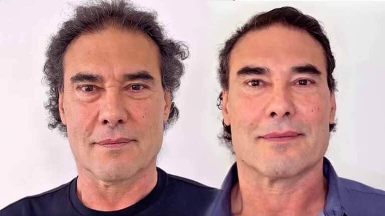 Eduardo Yáñez se quitó 20 años con un rejuvenecimiento facial de alto impacto