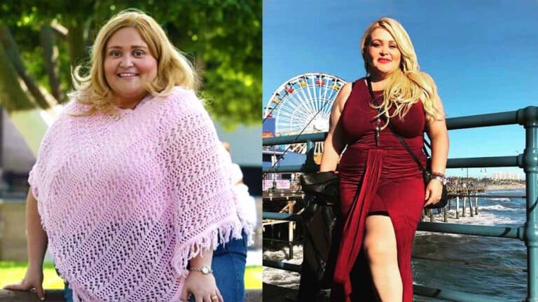 Tras perder 128 libras, Sheyla donó su piel para ayudar a niños quemados