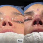 El cirujano colombiano arregló la nariz de la modelo, tras cuatro cirugías mal hechas por su colega mexicano