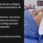 Un médico colombiano tomó el reto de reconstruirle la nariz a la modelo, describiendo en una historia de Instagram lo que presentaba al llegar a él