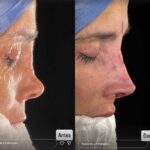 El cirujano colombiano Froilán Páez le acaba de reconstruir la nariz a Dorismar, en este antes y después, tras el mal trabajo que le hizo el médico mexicano