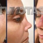 La revista TVnotas mostró imágenes de cómo le quedó el rostro con los retoques que le hizo un cirujano plástico mexicano