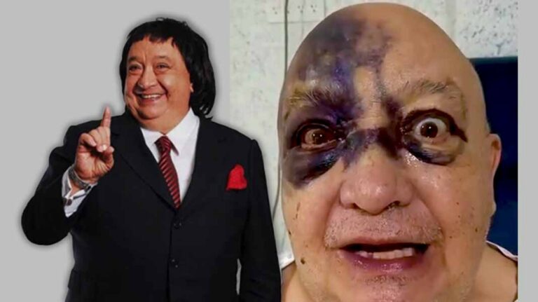 Amoratado y con hematomas: Así quedó Luis de Alba tras accidente